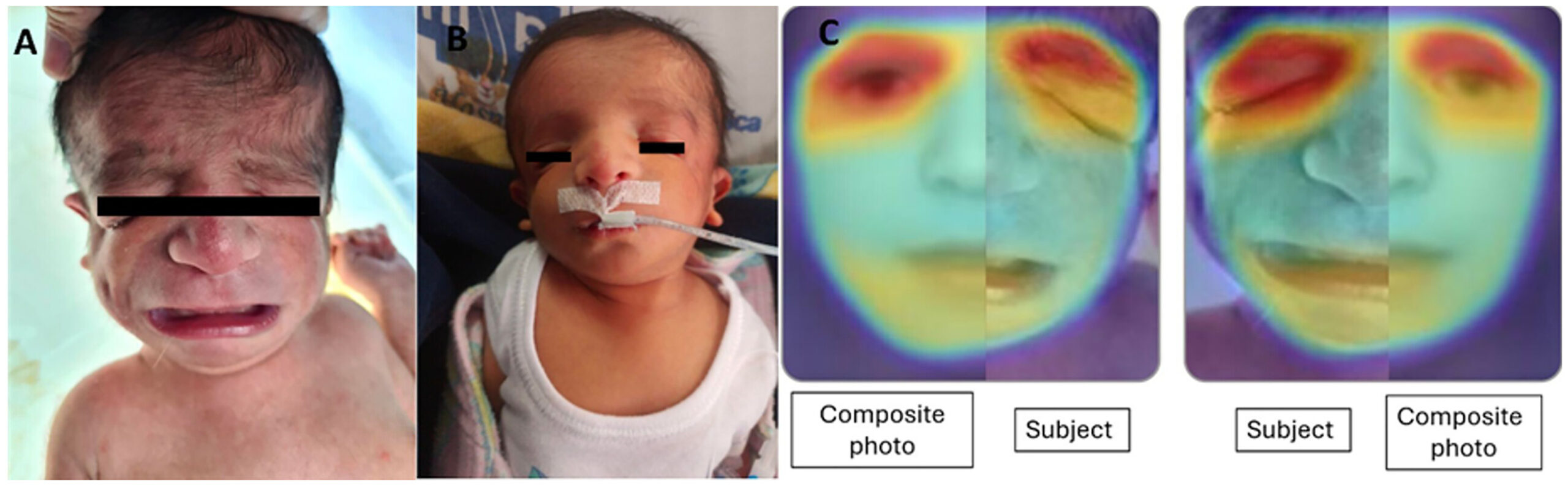 Novel nonsense mutation in the TCOF1 gene associated with treacher collins syndrome: A case report