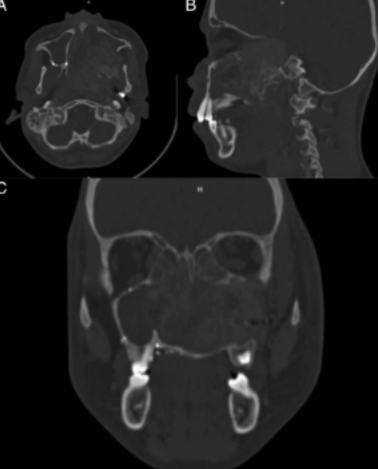 Resection of Juvenile Nasopharyngeal Angiofibroma Using Le Fort I Approach and Deep Hypothermic Circulatory Arrest